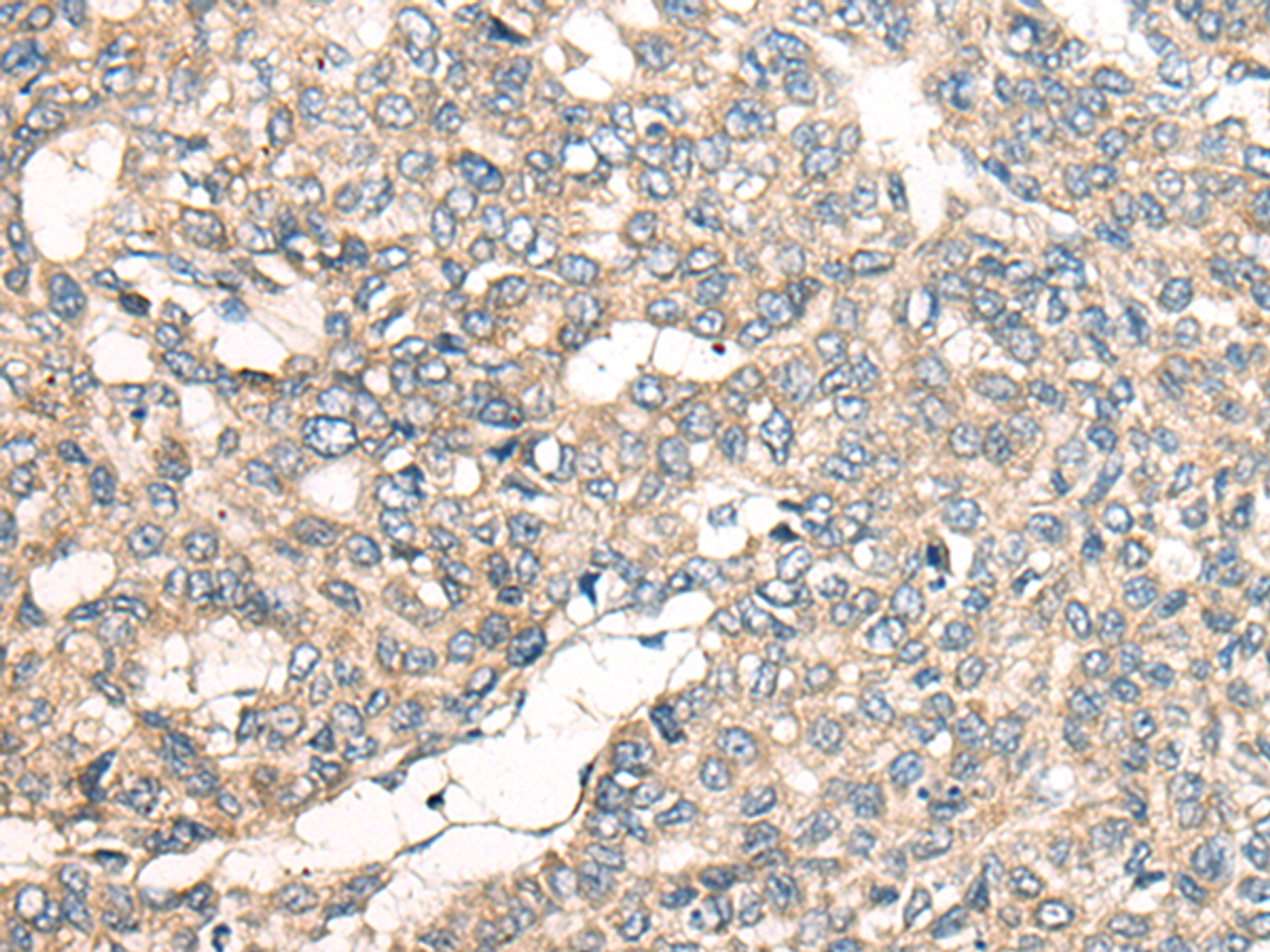 Immunohistochemistry of paraffin-embedded Human liver cancer tissue  using LRP1B Polyclonal Antibody at dilution of 1:50(×200)