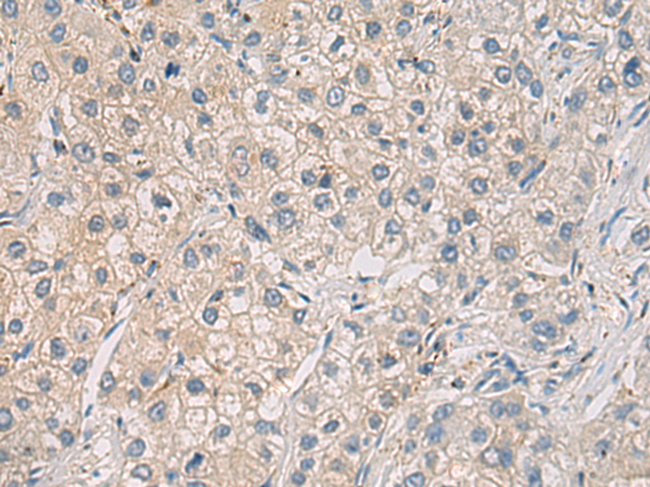 Immunohistochemistry of paraffin-embedded Human liver cancer tissue  using WFDC3 Polyclonal Antibody at dilution of 1:40(×200)