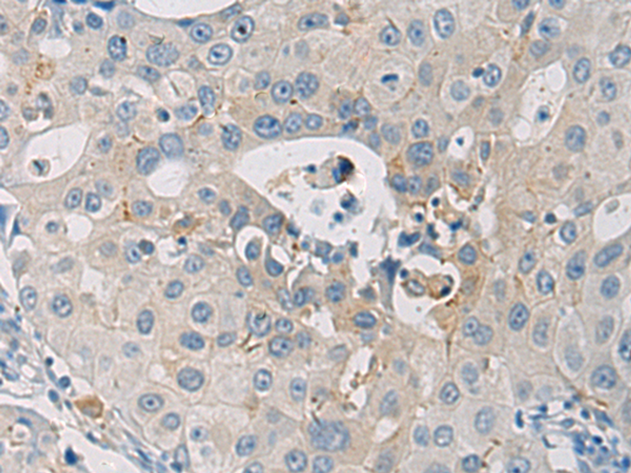 Immunohistochemistry of paraffin-embedded Human breast cancer tissue  using WFDC3 Polyclonal Antibody at dilution of 1:40(×200)