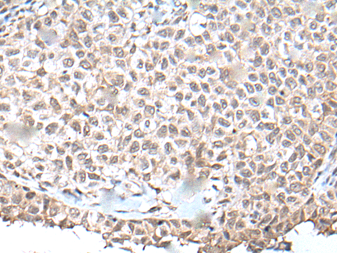 Immunohistochemistry of paraffin-embedded Human ovarian cancer tissue  using UBN1 Polyclonal Antibody at dilution of 1:130(×200)