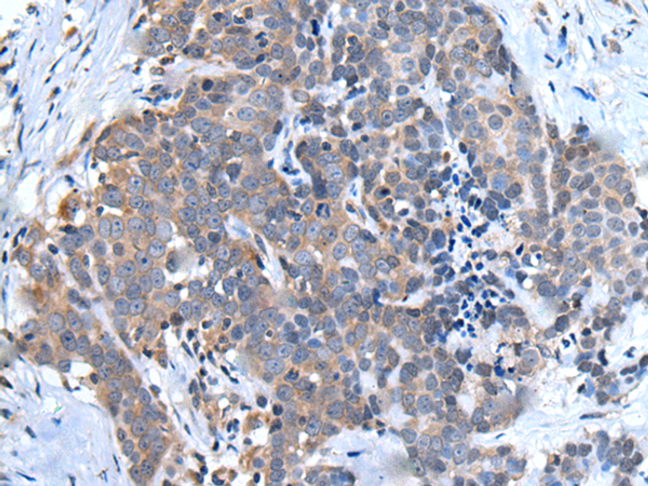 Immunohistochemistry of paraffin-embedded Human thyroid cancer tissue  using UBQLN2 Polyclonal Antibody at dilution of 1:45(×200)