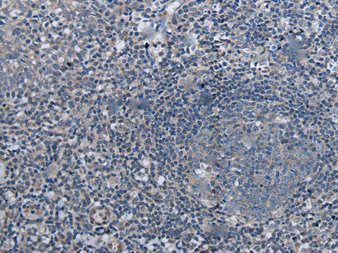 Immunohistochemistry of paraffin-embedded Human tonsil tissue  using UBR4 Polyclonal Antibody at dilution of 1:55(×200)