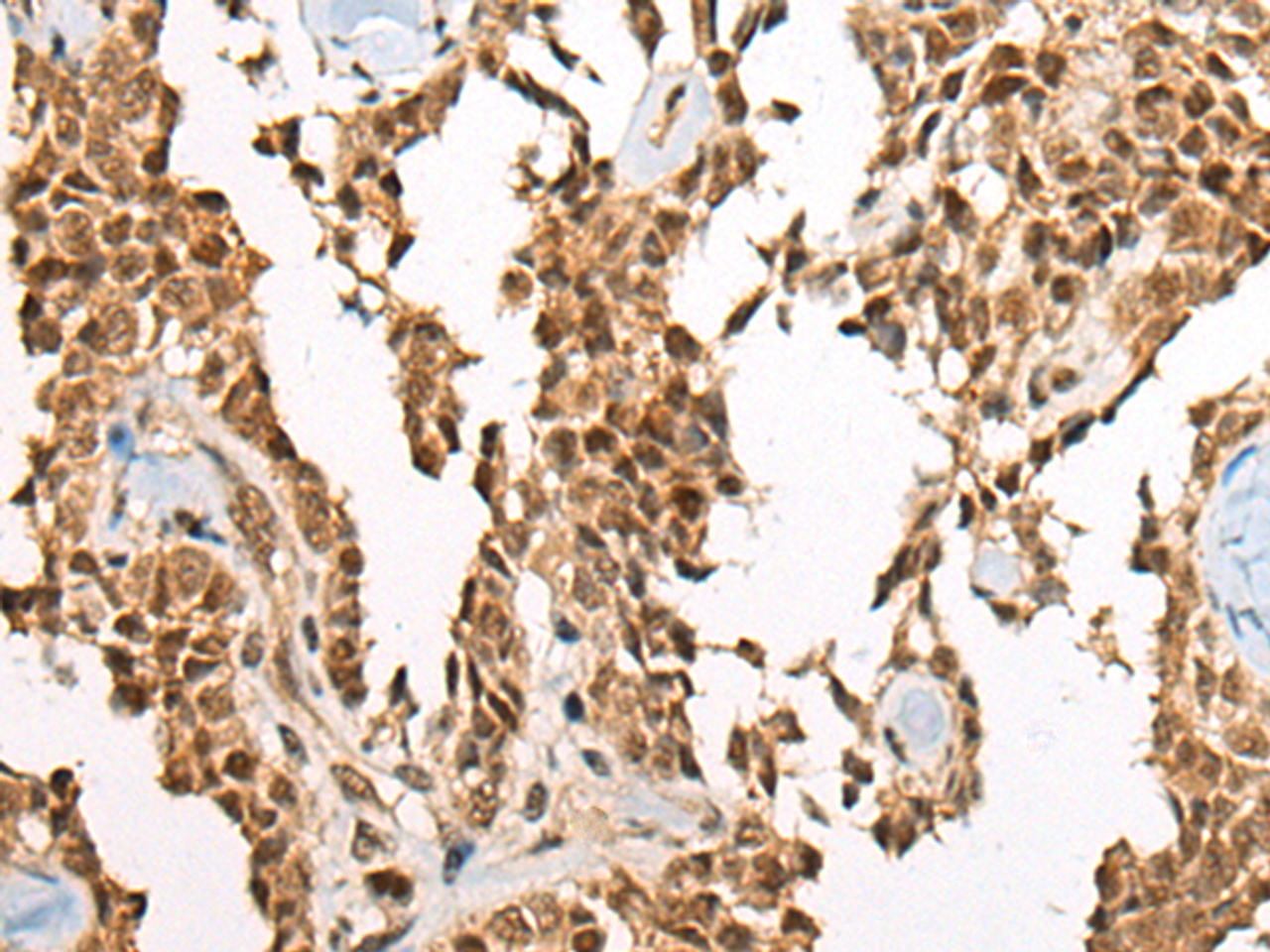 Immunohistochemistry of paraffin-embedded Human ovarian cancer tissue  using ATE1 Polyclonal Antibody at dilution of 1:60(×200)