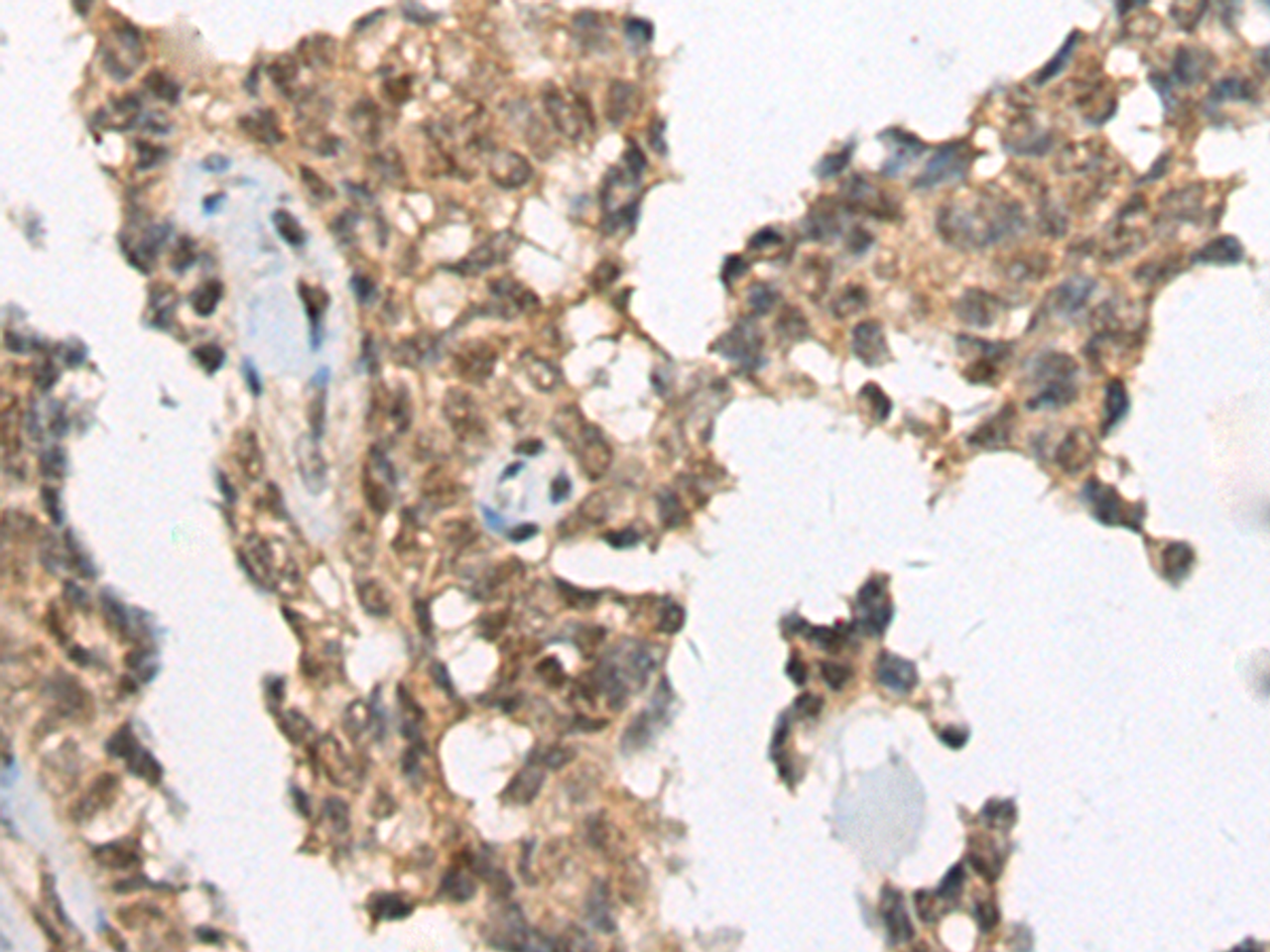 Immunohistochemistry of paraffin-embedded Human ovarian cancer tissue  using ATRX Polyclonal Antibody at dilution of 1:50(×200)