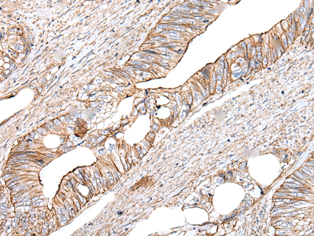 Immunohistochemistry of paraffin-embedded Human colorectal cancer tissue  using BLVRB Polyclonal Antibody at dilution of 1:65(×200)