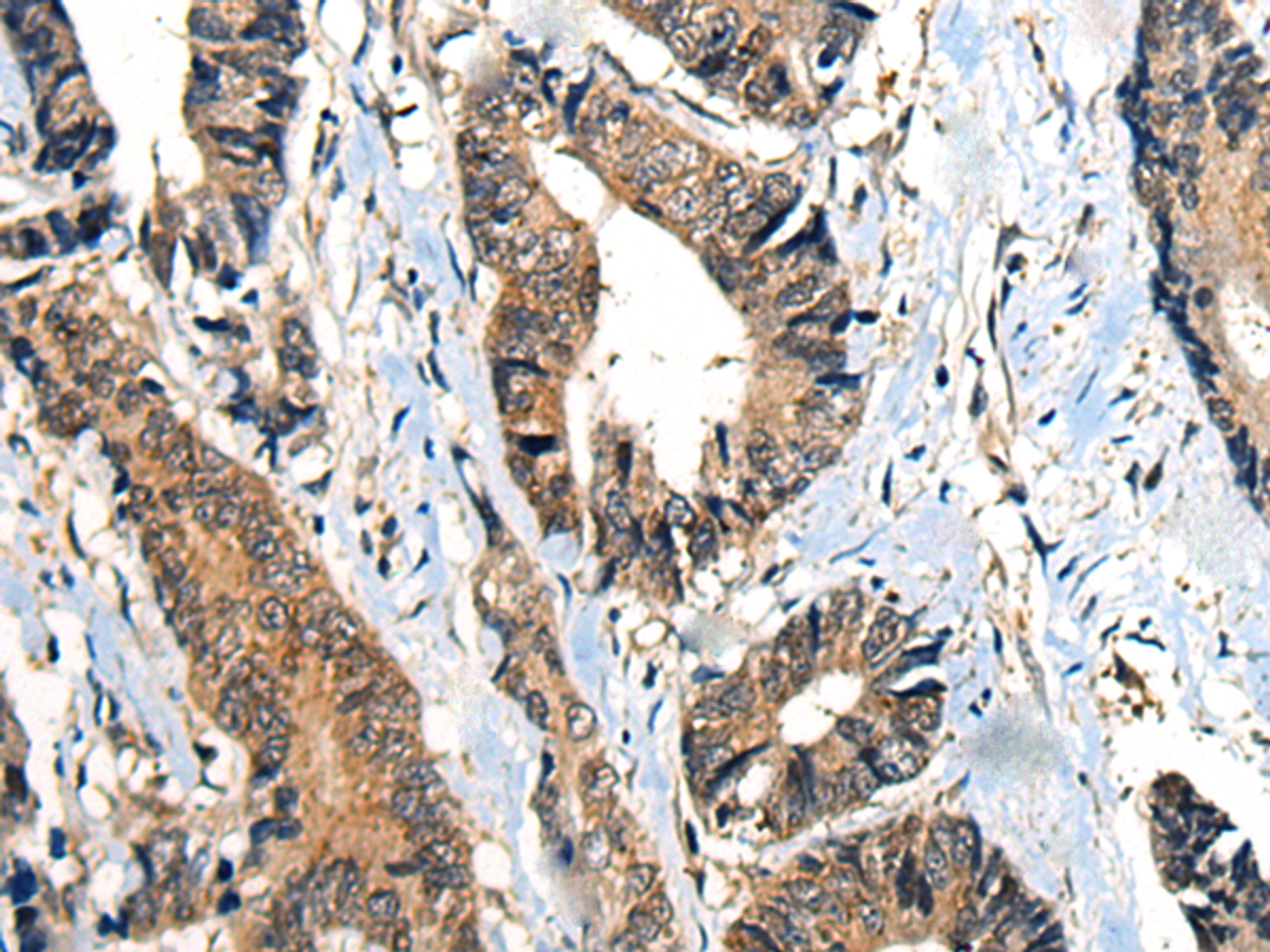Immunohistochemistry of paraffin-embedded Human gastric cancer tissue  using BMPER Polyclonal Antibody at dilution of 1:40(×200)