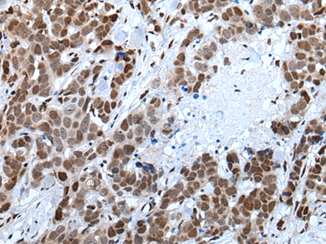 Immunohistochemistry of paraffin-embedded Human thyroid cancer tissue  using CELF5 Polyclonal Antibody at dilution of 1:65(×200)