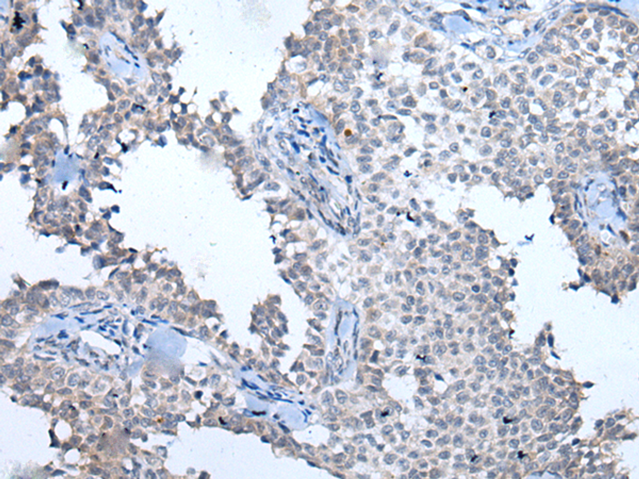 Immunohistochemistry of paraffin-embedded Human ovarian cancer tissue  using ATM Polyclonal Antibody at dilution of 1:65(×200)