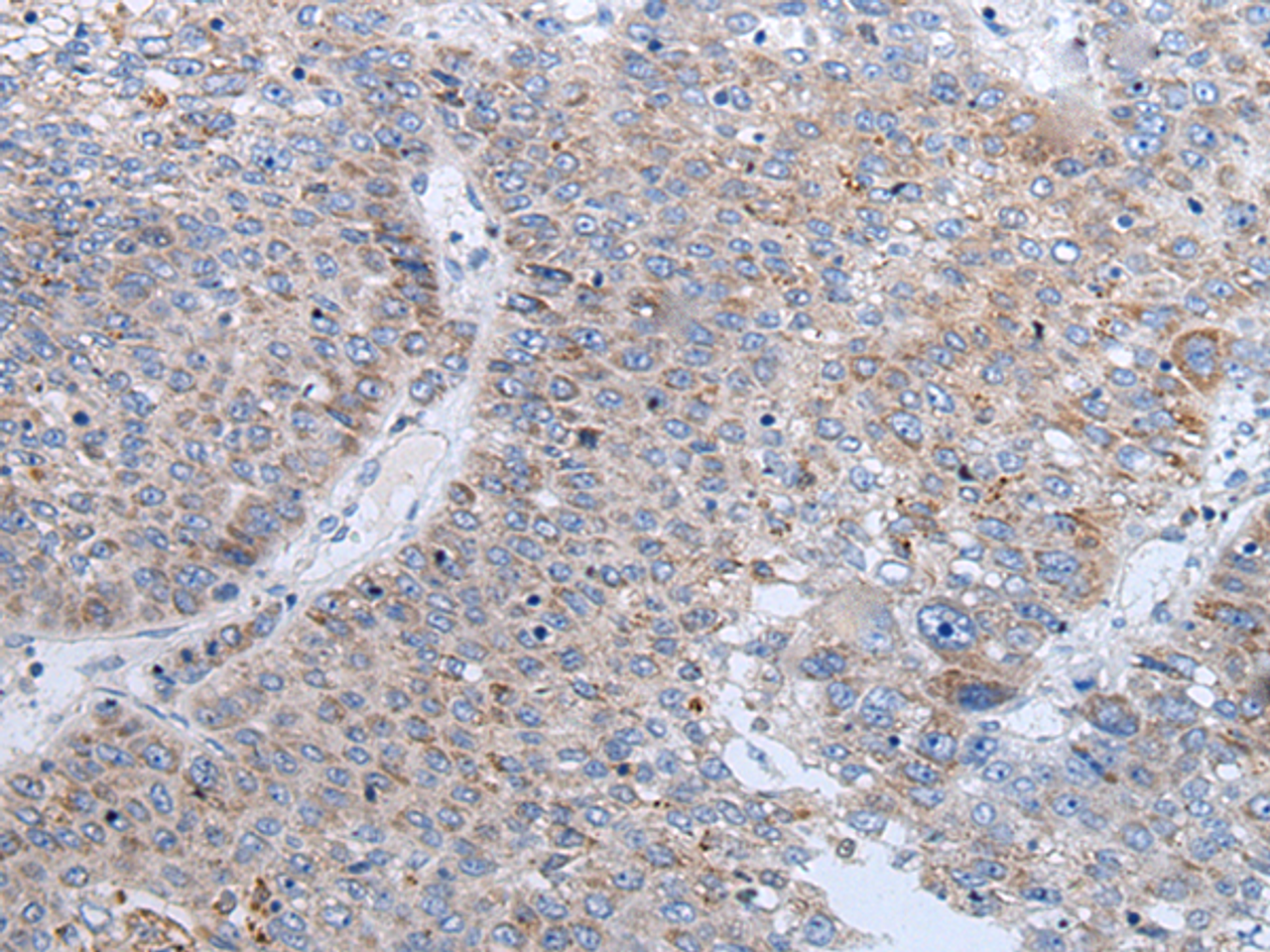 Immunohistochemistry of paraffin-embedded Human liver cancer tissue  using ENPP2 Polyclonal Antibody at dilution of 1:50(×200)