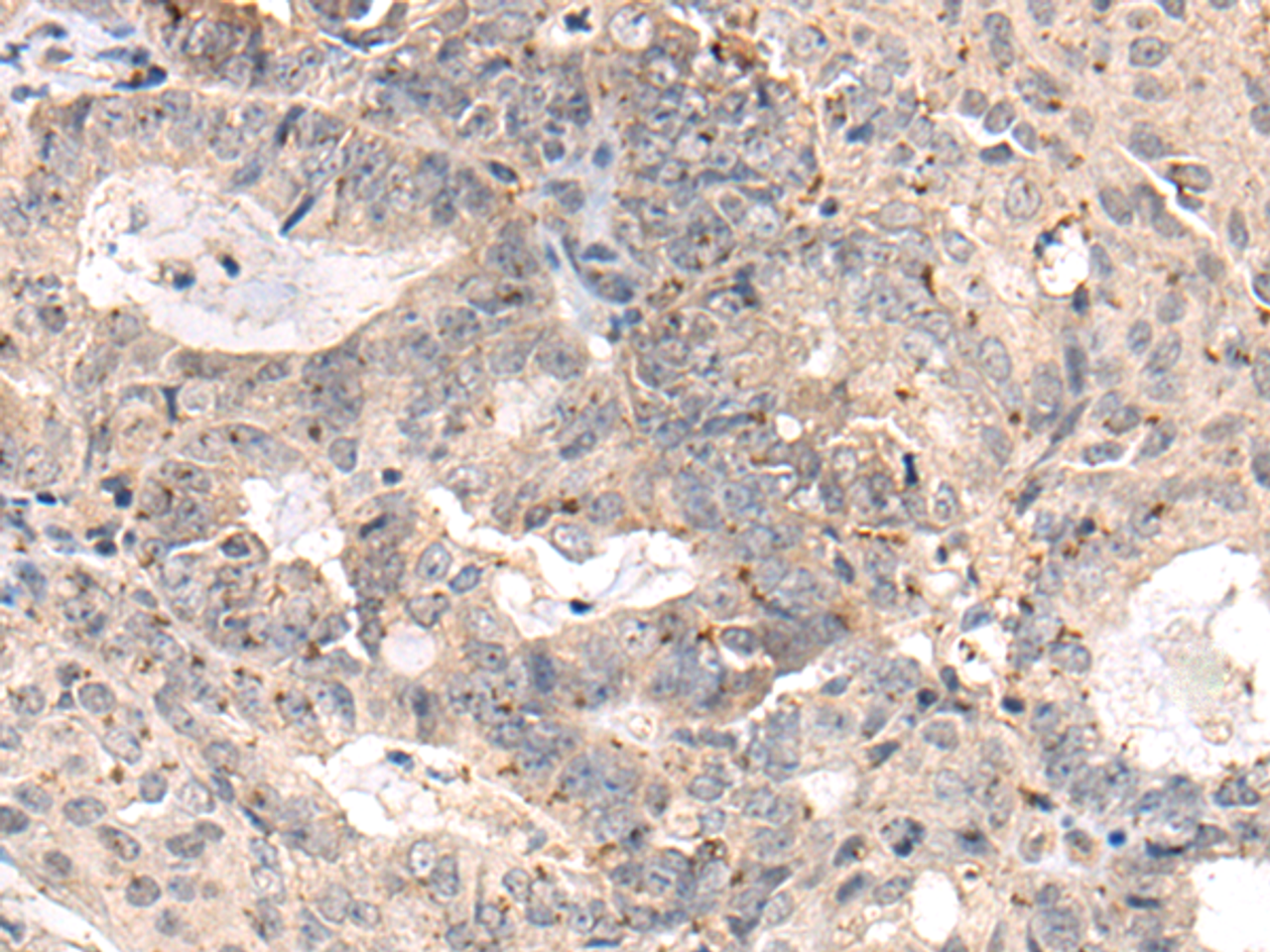 Immunohistochemistry of paraffin-embedded Human ovarian cancer tissue  using MEDAG Polyclonal Antibody at dilution of 1:75(×200)