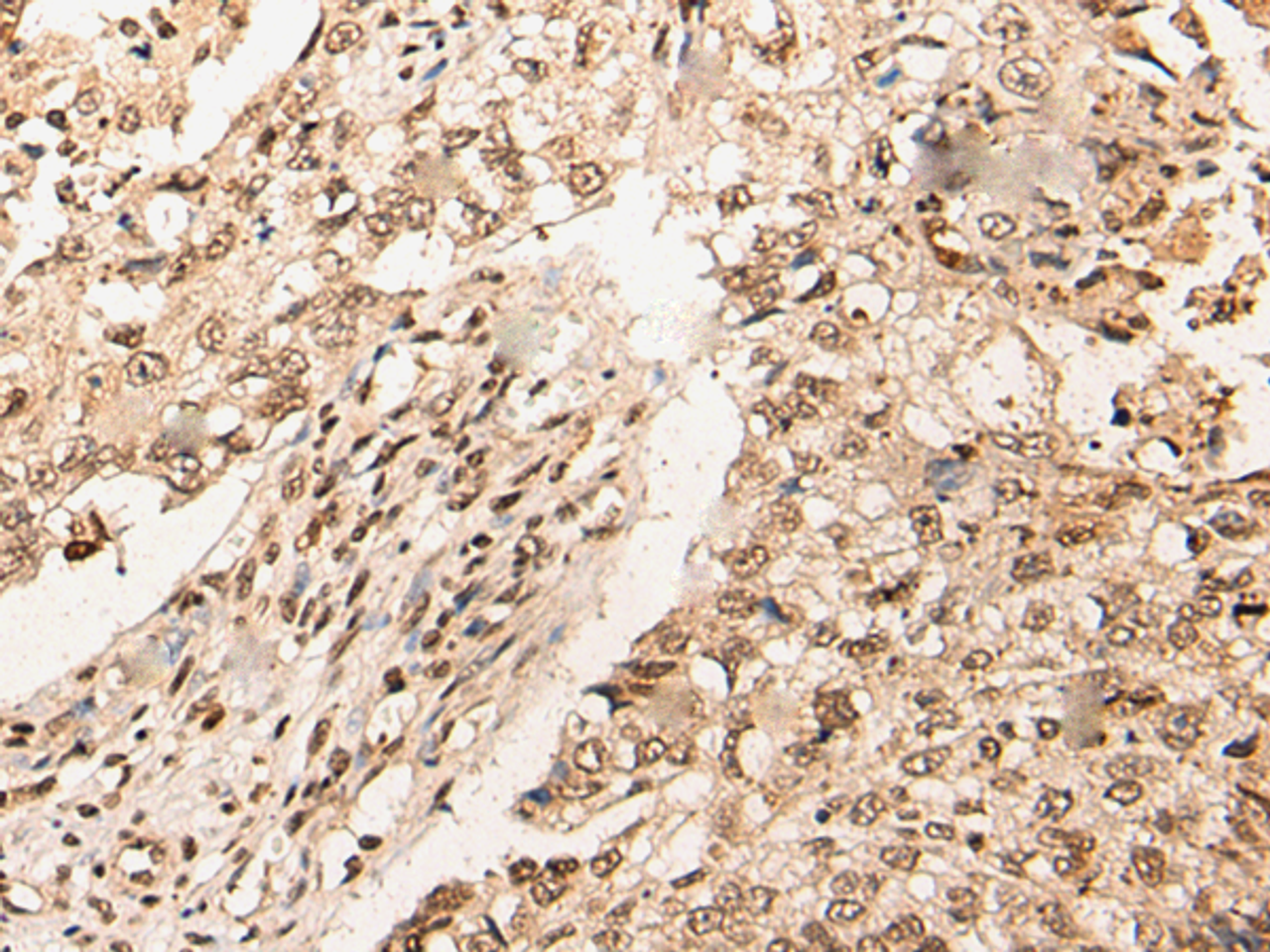 Immunohistochemistry of paraffin-embedded Human lung cancer tissue  using URI1 Polyclonal Antibody at dilution of 1:45(×200)