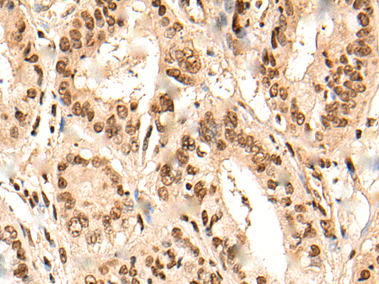 Immunohistochemistry of paraffin-embedded Human liver cancer tissue  using URI1 Polyclonal Antibody at dilution of 1:45(×200)