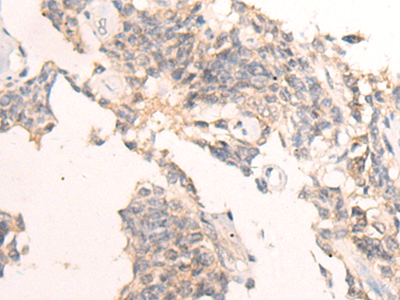 Immunohistochemistry of paraffin-embedded Human ovarian cancer tissue  using IBA57 Polyclonal Antibody at dilution of 1:65(×200)