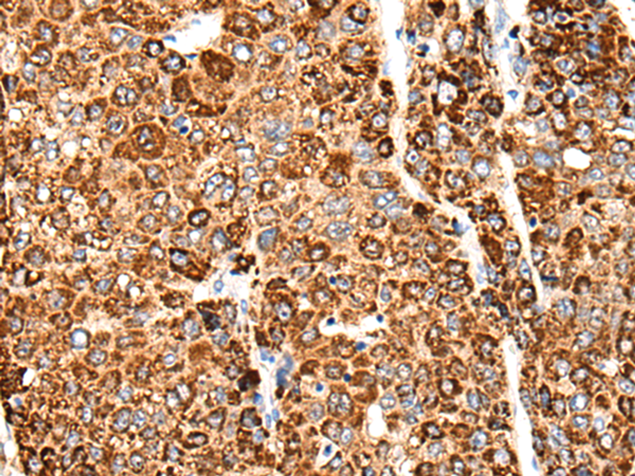 Immunohistochemistry of paraffin-embedded Human liver cancer tissue  using CACNG5 Polyclonal Antibody at dilution of 1:50(×200)