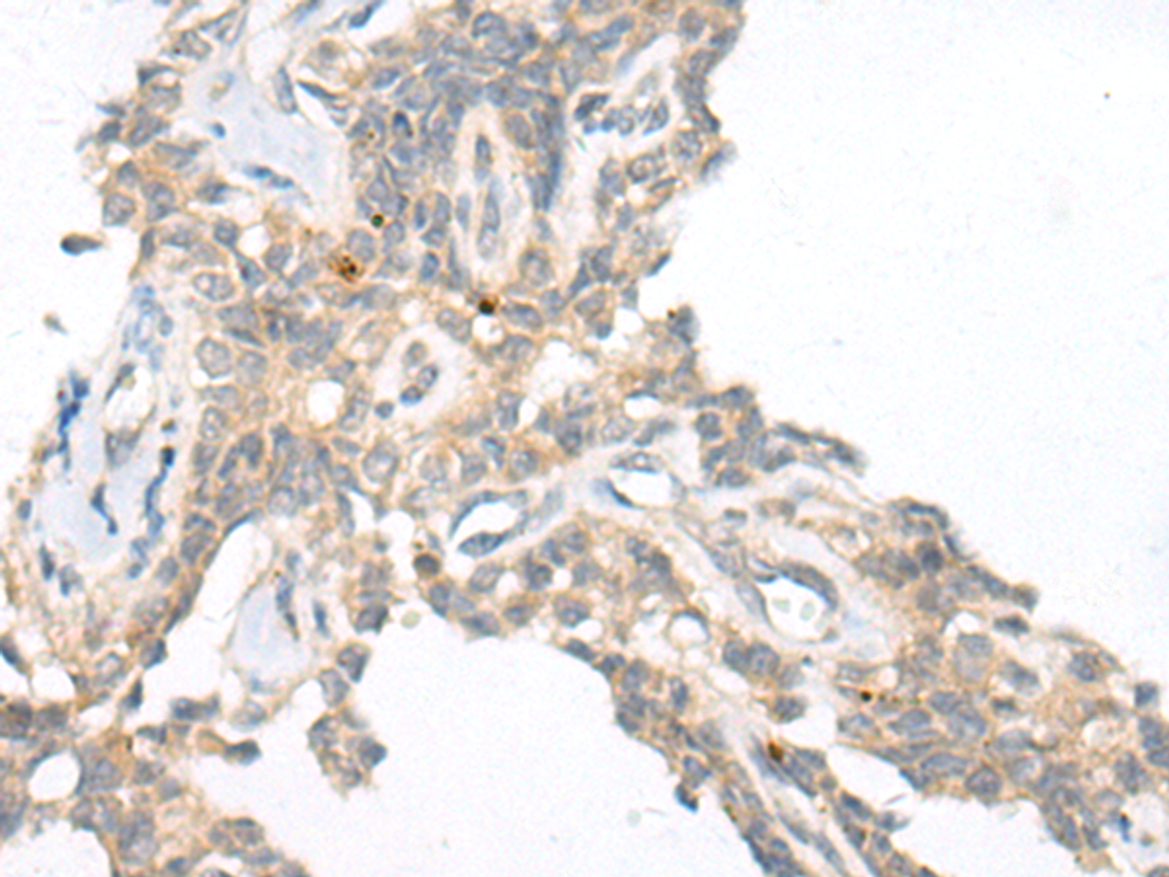 Immunohistochemistry of paraffin-embedded Human ovarian cancer tissue  using CAMK2A Polyclonal Antibody at dilution of 1:55(×200)