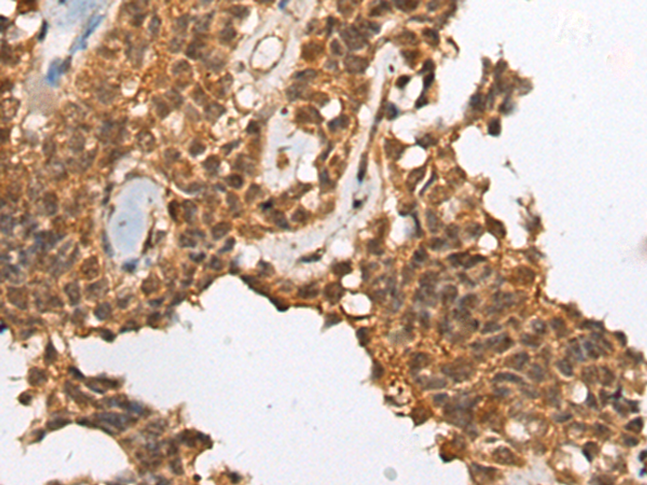 Immunohistochemistry of paraffin-embedded Human ovarian cancer tissue  using CASP8 Polyclonal Antibody at dilution of 1:35(×200)