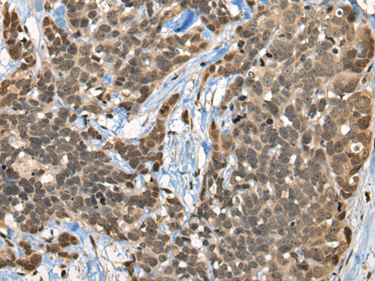 Immunohistochemistry of paraffin-embedded Human thyroid cancer tissue  using CBFA2T3 Polyclonal Antibody at dilution of 1:45(×200)