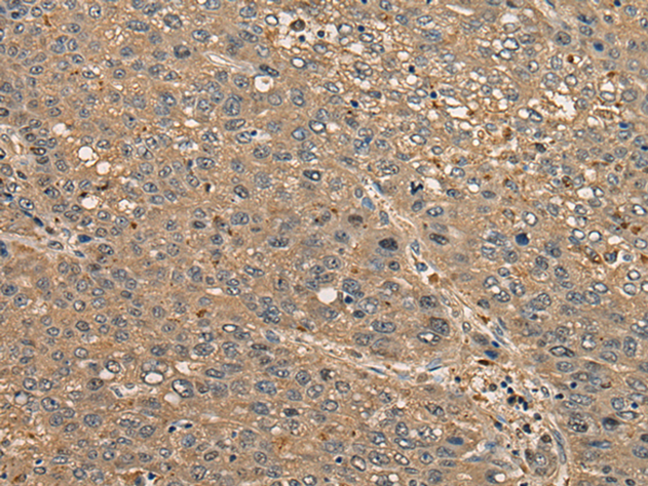 Immunohistochemistry of paraffin-embedded Human liver cancer tissue  using CCDC85C Polyclonal Antibody at dilution of 1:30(×200)