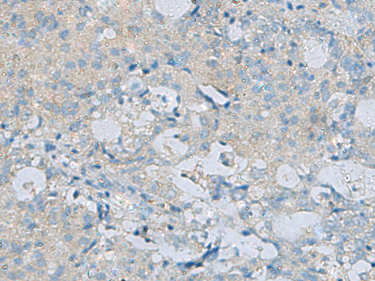 Immunohistochemistry of paraffin-embedded Human ovarian cancer tissue  using CDH12 Polyclonal Antibody at dilution of 1:60(×200)