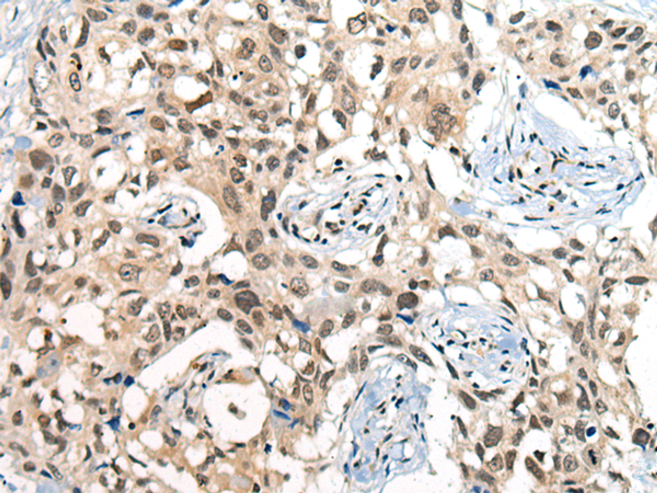 Immunohistochemistry of paraffin-embedded Human lung cancer tissue  using CDKL2 Polyclonal Antibody at dilution of 1:25(×200)