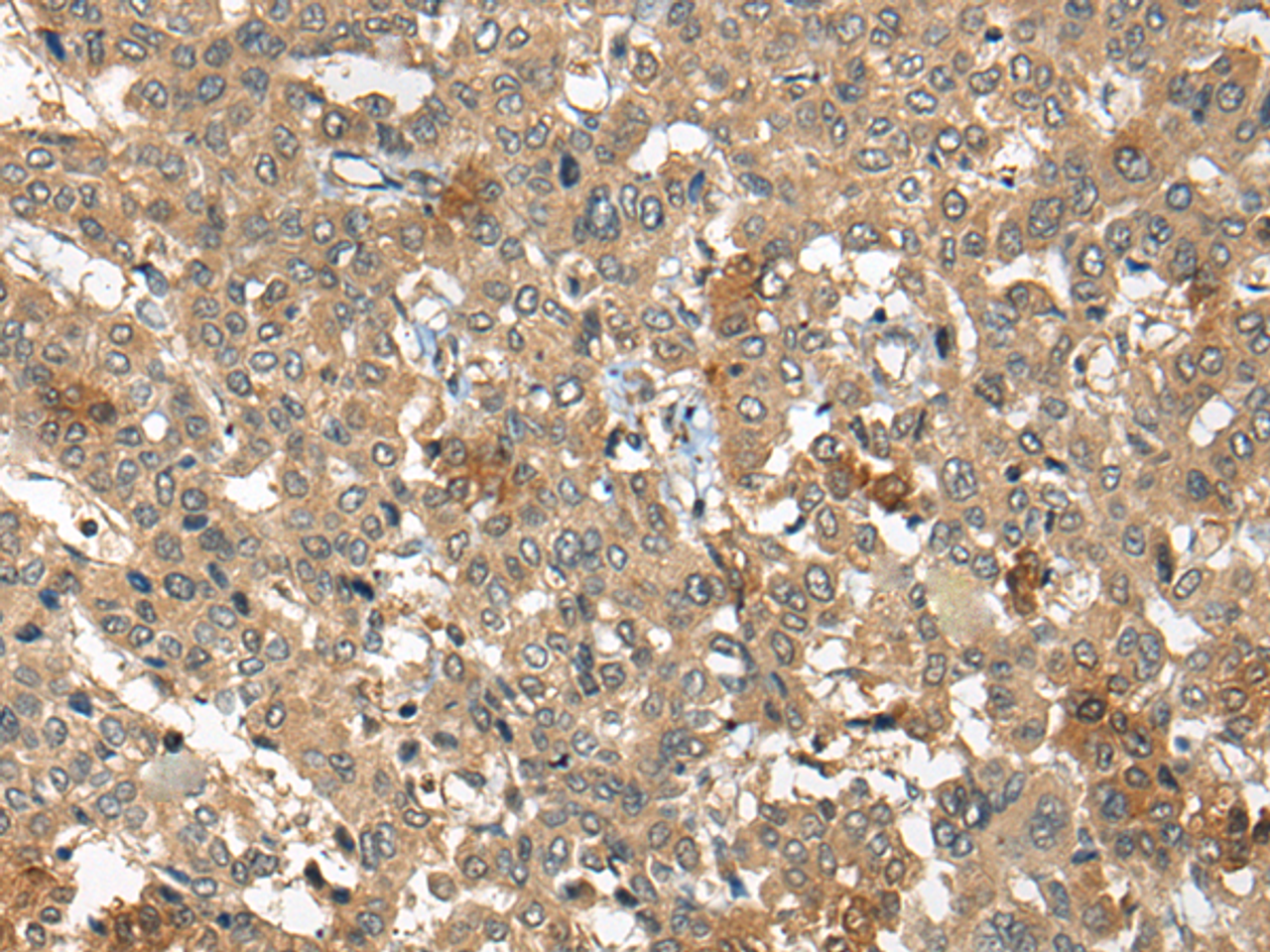 Immunohistochemistry of paraffin-embedded Human liver cancer tissue  using ARCN1 Polyclonal Antibody at dilution of 1:50(×200)