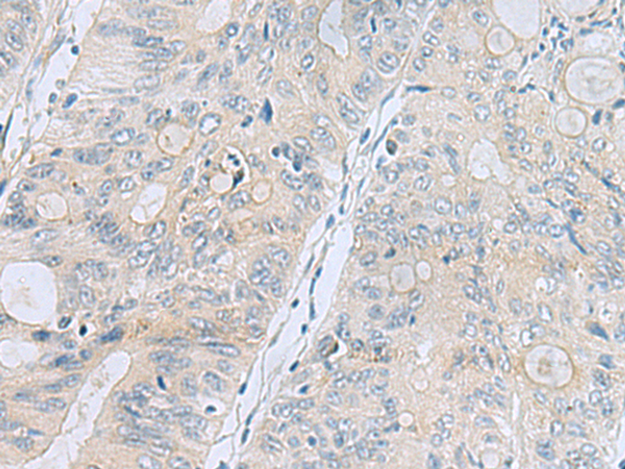 Immunohistochemistry of paraffin-embedded Human colorectal cancer tissue  using APOBR Polyclonal Antibody at dilution of 1:35(×200)