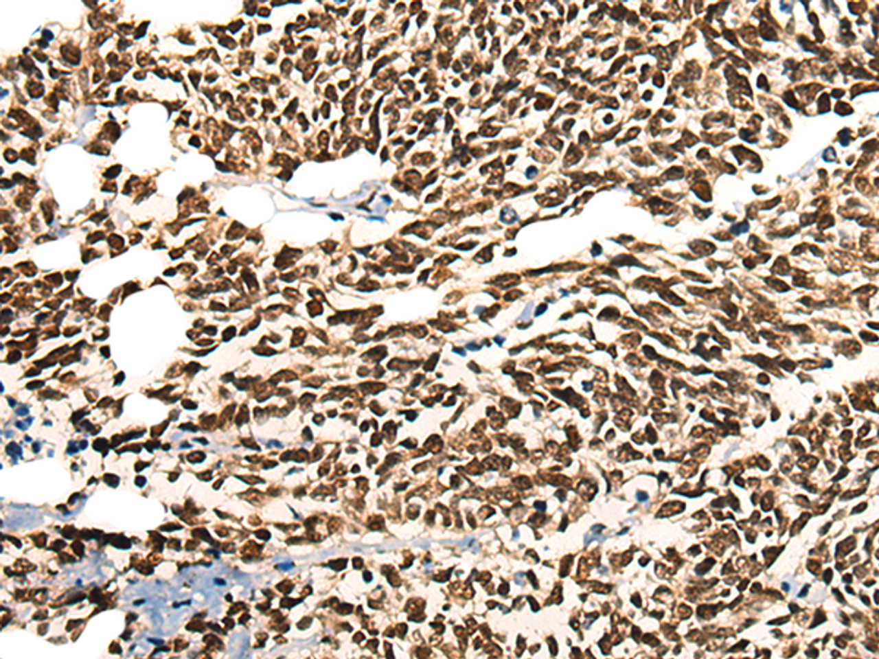 Immunohistochemistry of paraffin-embedded Human lung cancer tissue  using MORF4L2 Polyclonal Antibody at dilution of 1:25(×200)