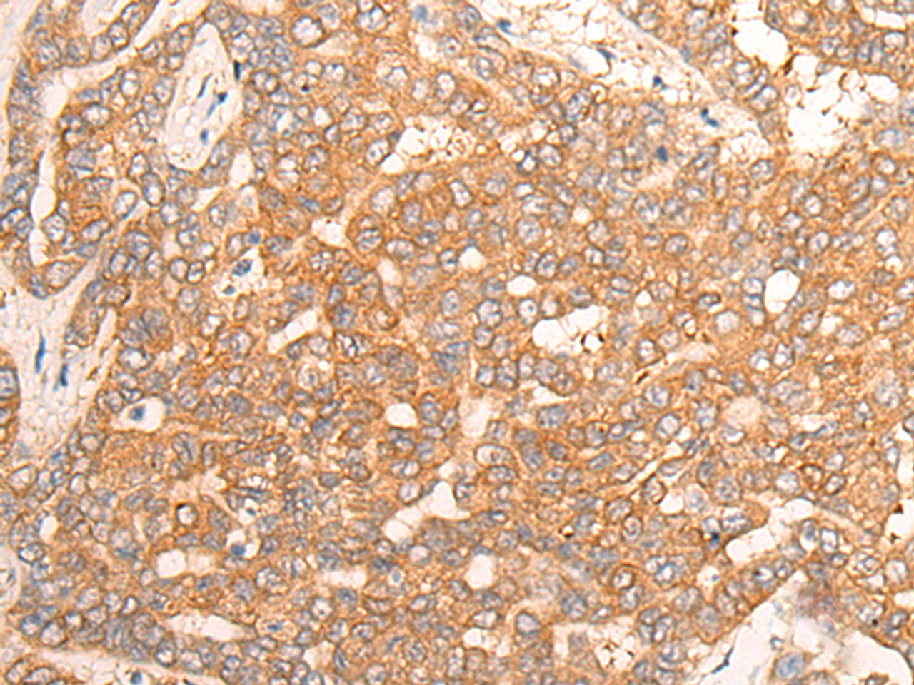 Immunohistochemistry of paraffin-embedded Human liver cancer tissue  using CPS1 Polyclonal Antibody at dilution of 1:35(×200)