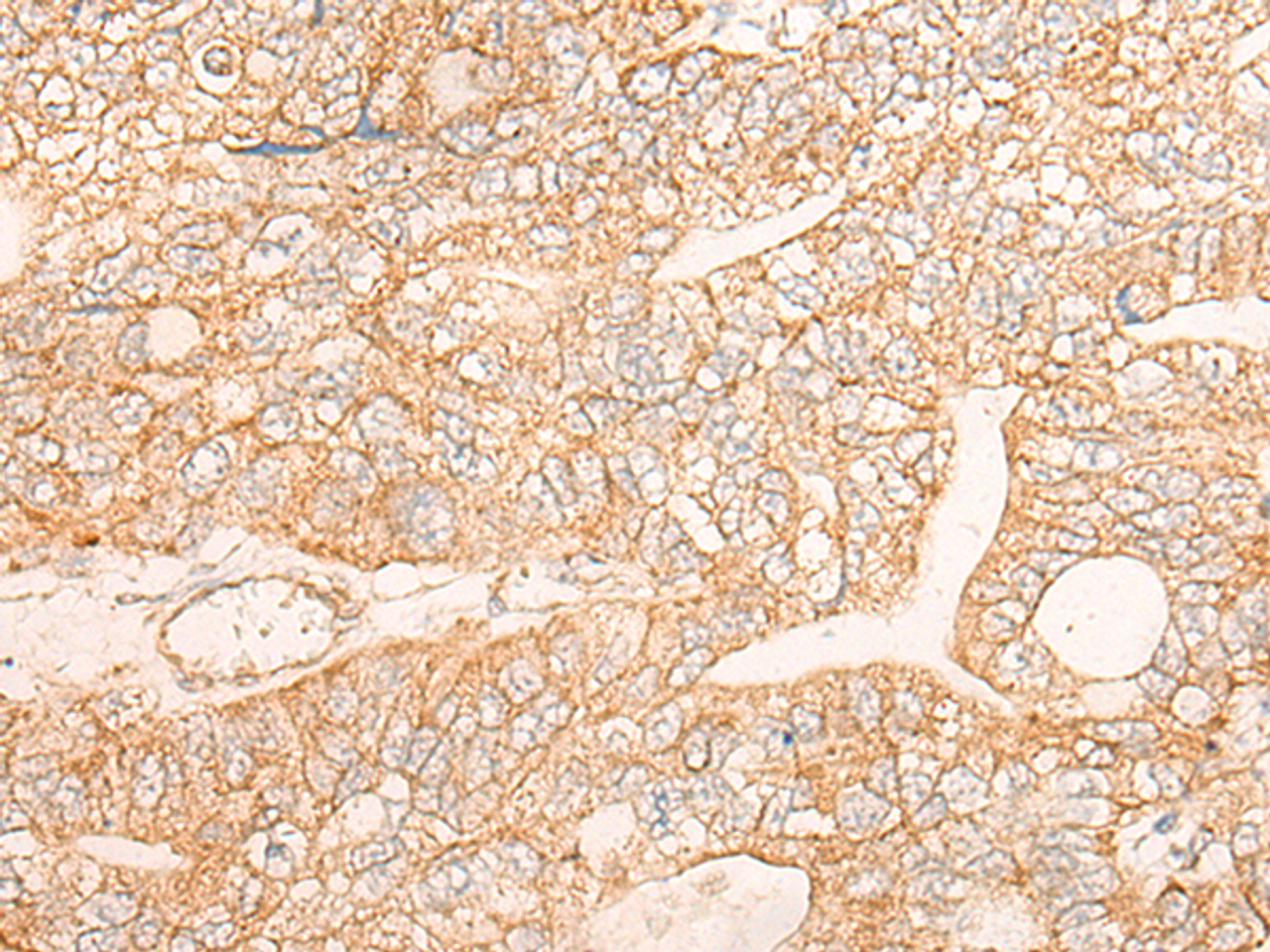 Immunohistochemistry of paraffin-embedded Human gastric cancer tissue  using KRT9 Polyclonal Antibody at dilution of 1:30(×200)