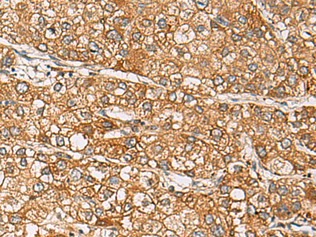 Immunohistochemistry of paraffin-embedded Human liver cancer tissue  using DCAF12 Polyclonal Antibody at dilution of 1:65(×200)