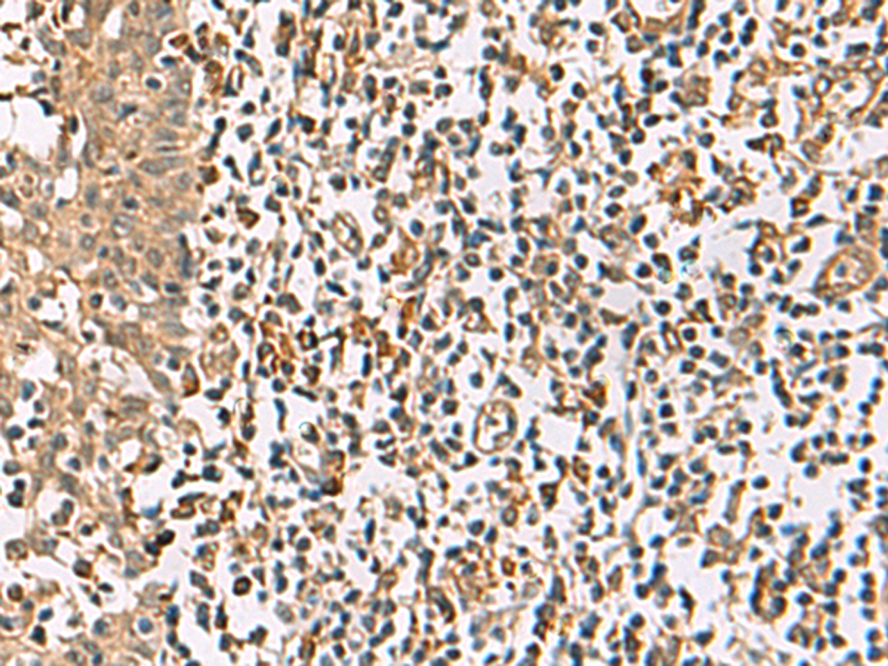 Immunohistochemistry of paraffin-embedded Human tonsil tissue  using DCAF12 Polyclonal Antibody at dilution of 1:65(×200)
