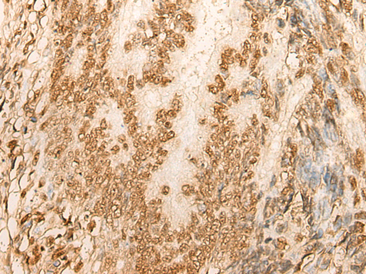Immunohistochemistry of paraffin-embedded Human colorectal cancer tissue  using HIST1H2BA Polyclonal Antibody at dilution of 1:45(×200)