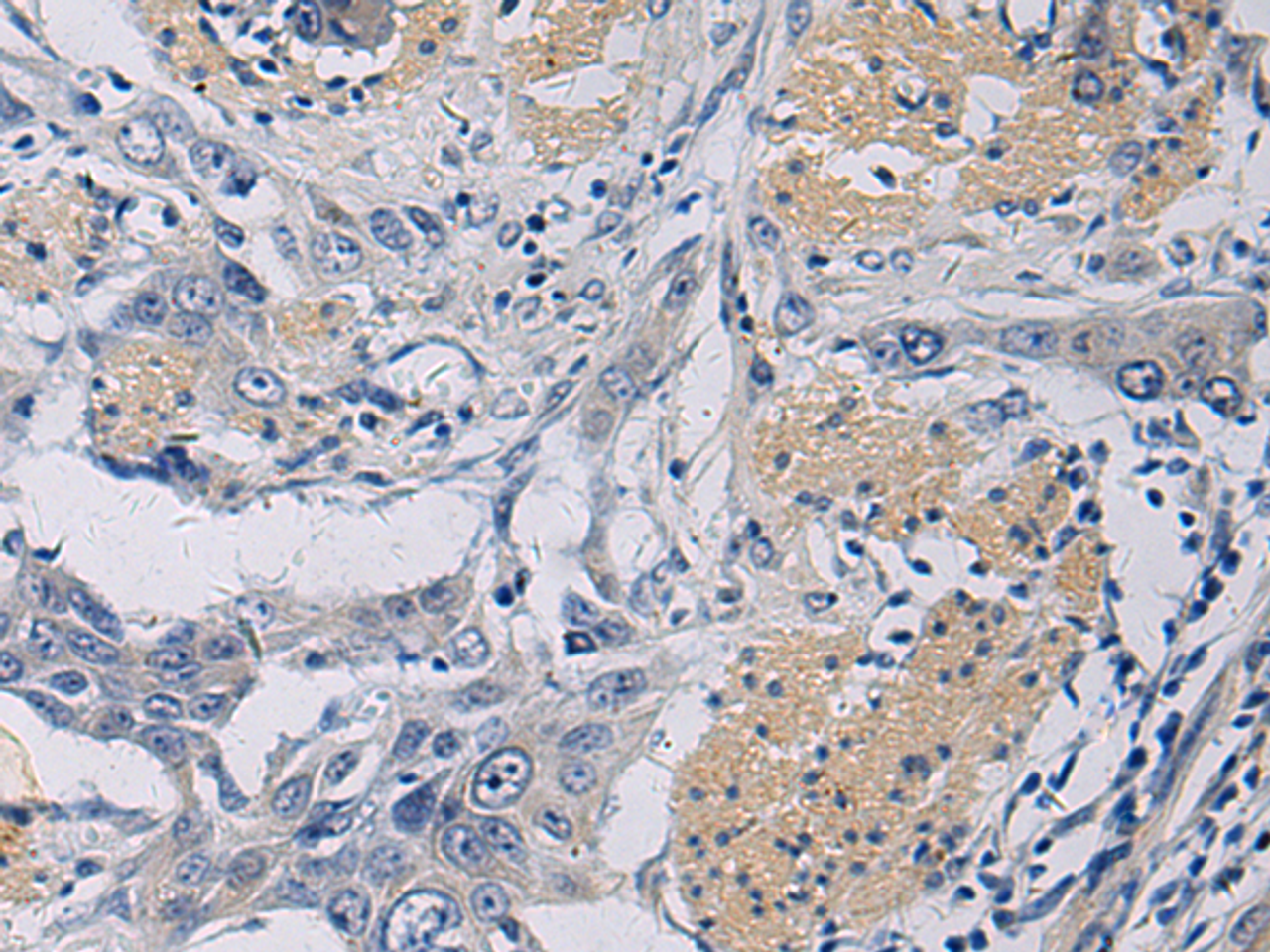 Immunohistochemistry of paraffin-embedded Human esophagus cancer tissue  using KLF1 Polyclonal Antibody at dilution of 1:35(×200)