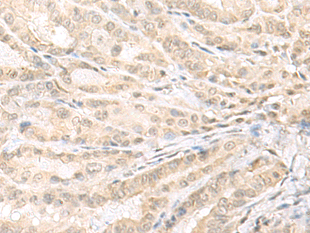 Immunohistochemistry of paraffin-embedded Human thyroid cancer tissue  using EMX1 Polyclonal Antibody at dilution of 1:25(×200)