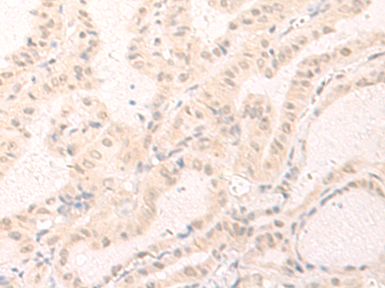 Immunohistochemistry of paraffin-embedded Human thyroid cancer tissue  using IL7 Polyclonal Antibody at dilution of 1:30(×200)
