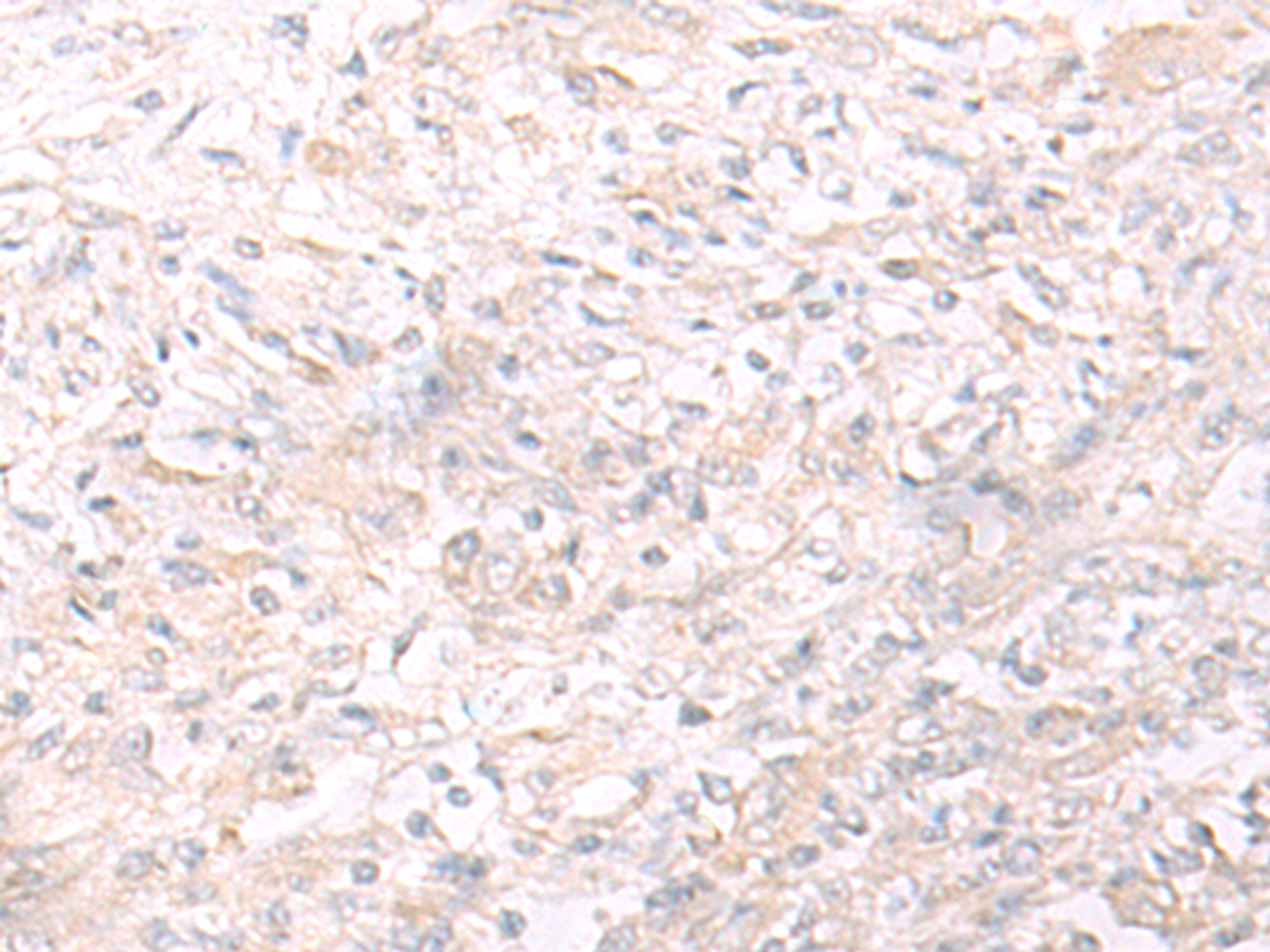 Immunohistochemistry of paraffin-embedded Human liver cancer tissue  using IL26 Polyclonal Antibody at dilution of 1:65(×200)