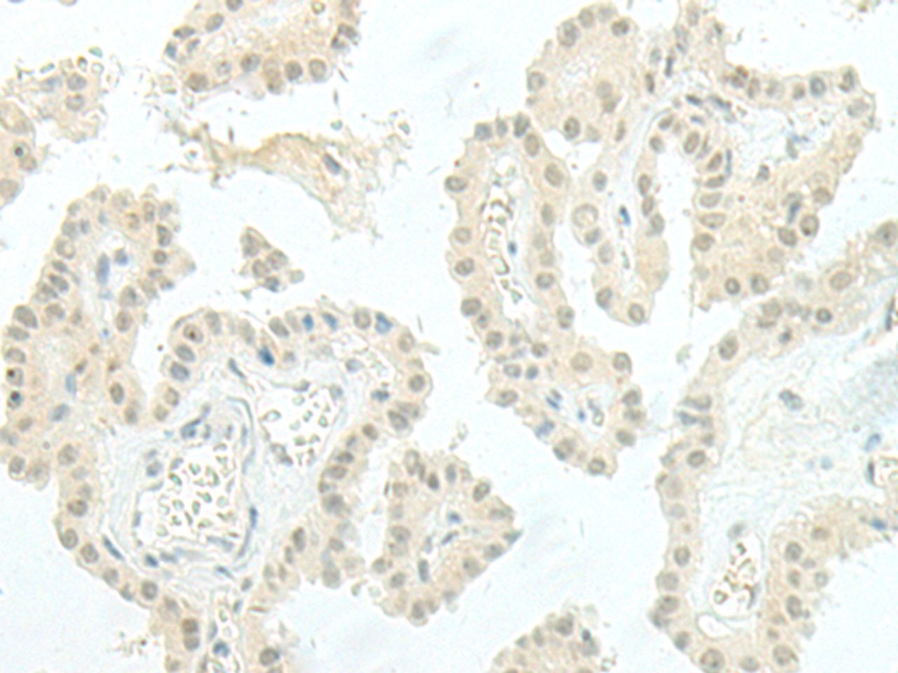 Immunohistochemistry of paraffin-embedded Human thyroid cancer tissue  using ESRP2 Polyclonal Antibody at dilution of 1:95(×200)