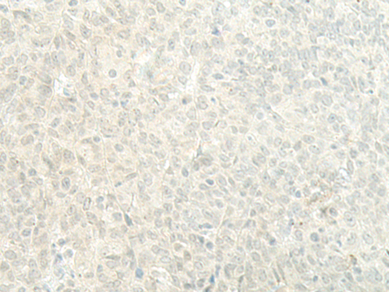 Immunohistochemistry of paraffin-embedded Human ovarian cancer tissue  using ESRP2 Polyclonal Antibody at dilution of 1:95(×200)