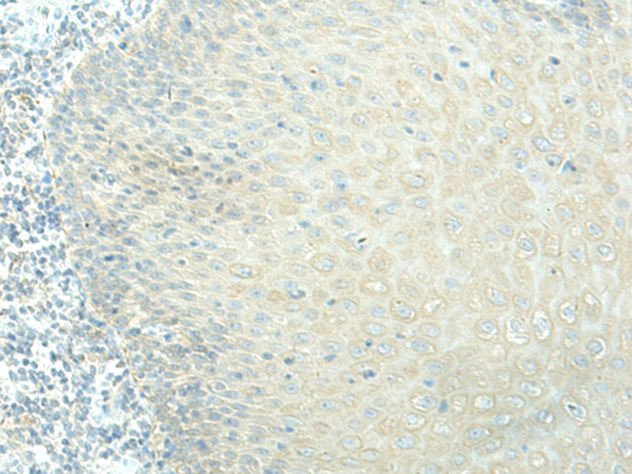Immunohistochemistry of paraffin-embedded Human esophagus cancer tissue  using EVI2B Polyclonal Antibody at dilution of 1:40(×200)