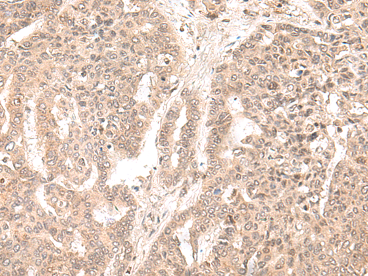 Immunohistochemistry of paraffin-embedded Human liver cancer tissue  using EXOSC9 Polyclonal Antibody at dilution of 1:35(×200)