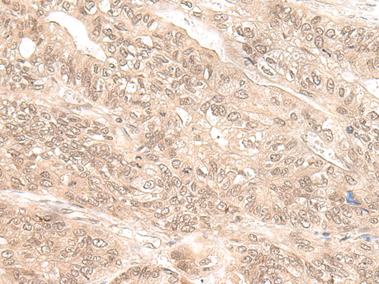 Immunohistochemistry of paraffin-embedded Human gastric cancer tissue  using EXOSC9 Polyclonal Antibody at dilution of 1:35(×200)