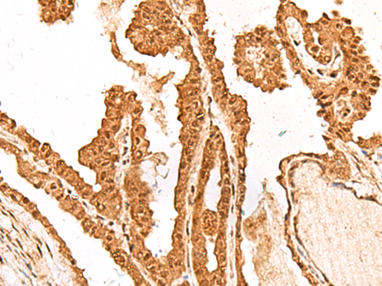 Immunohistochemistry of paraffin-embedded Human thyroid cancer tissue  using FAM111B Polyclonal Antibody at dilution of 1:50(×200)
