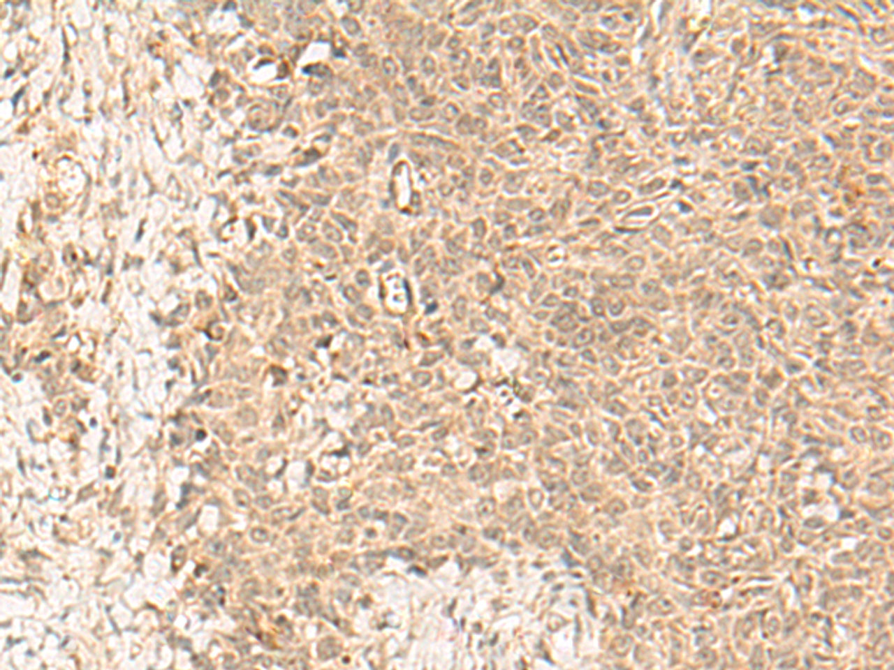 Immunohistochemistry of paraffin-embedded Human ovarian cancer tissue  using FBXL4 Polyclonal Antibody at dilution of 1:25(×200)