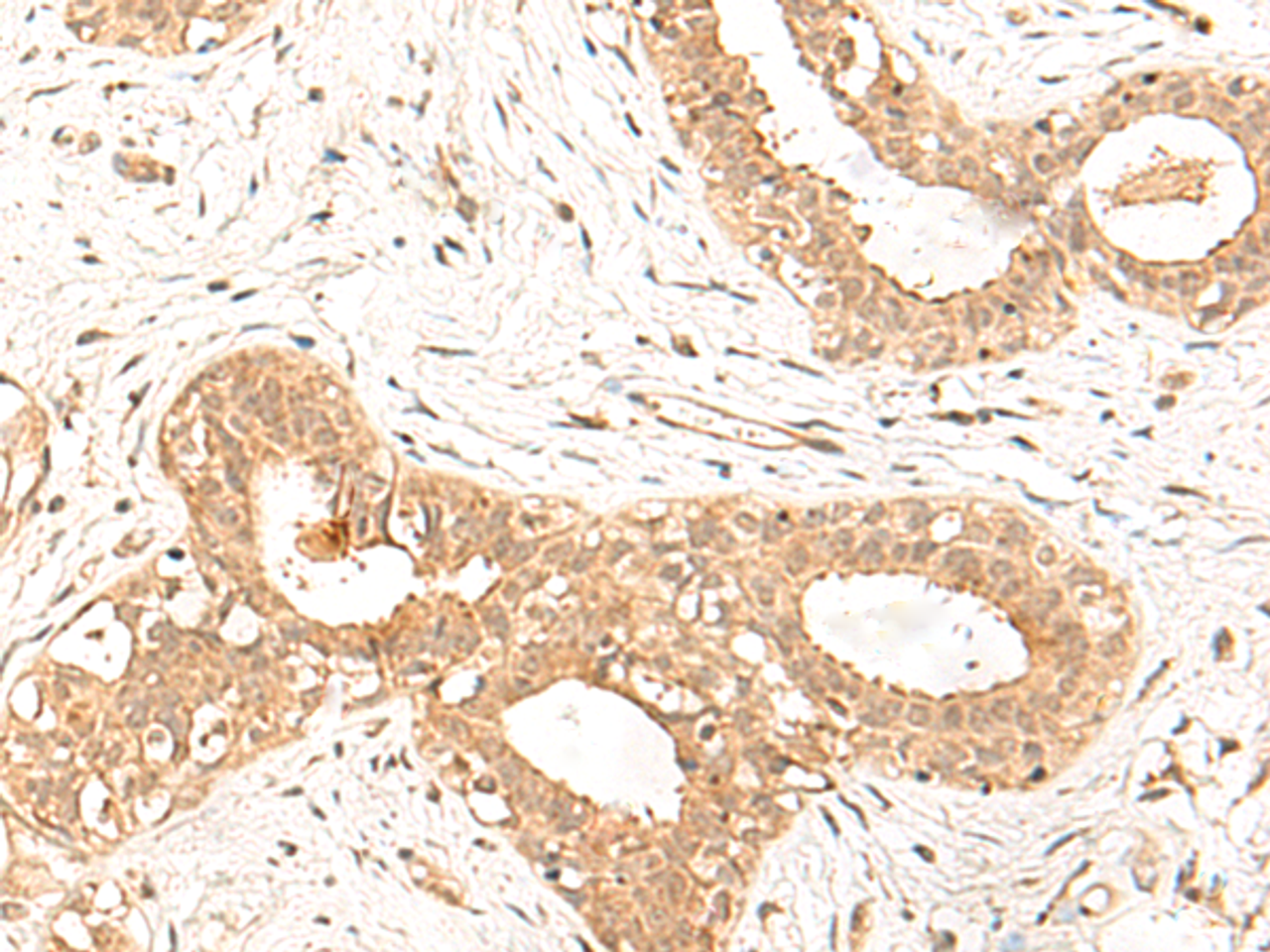 Immunohistochemistry of paraffin-embedded Human breast cancer tissue  using FBXL4 Polyclonal Antibody at dilution of 1:25(×200)