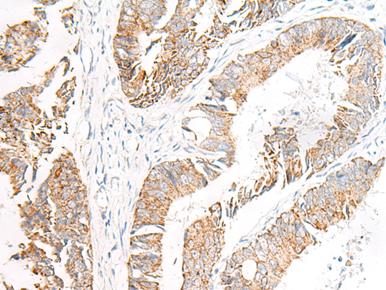 Immunohistochemistry of paraffin-embedded Human colorectal cancer tissue  using FGR Polyclonal Antibody at dilution of 1:70(×200)