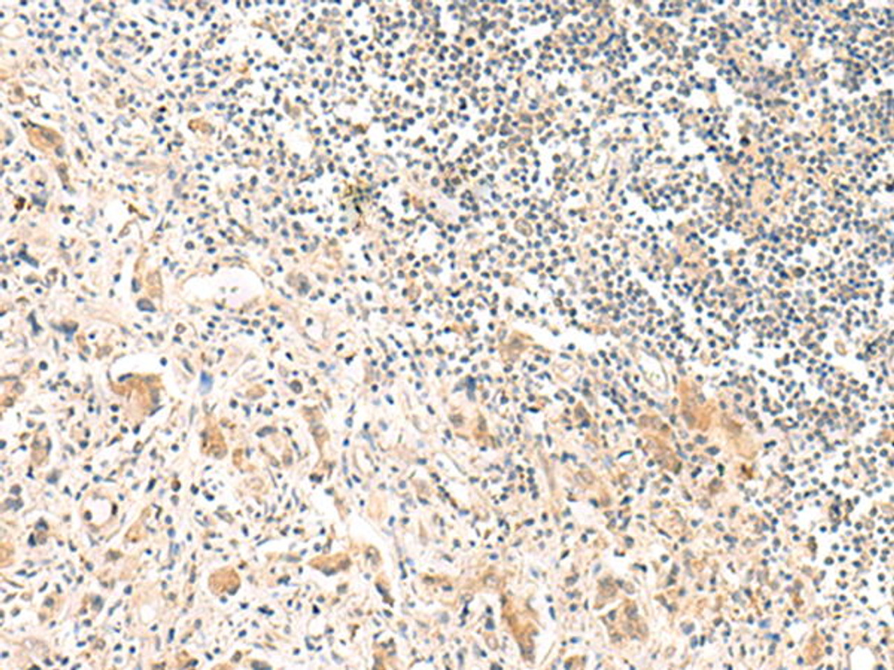 Immunohistochemistry of paraffin-embedded Human prost at e cancer tissue  using FNBP1L Polyclonal Antibody at dilution of 1:30(×200)