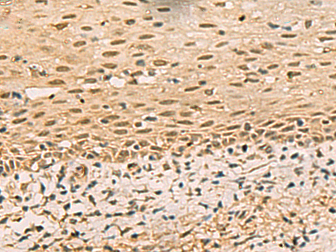 Immunohistochemistry of paraffin-embedded Human cervical cancer tissue  using FOXH1 Polyclonal Antibody at dilution of 1:40(×200)