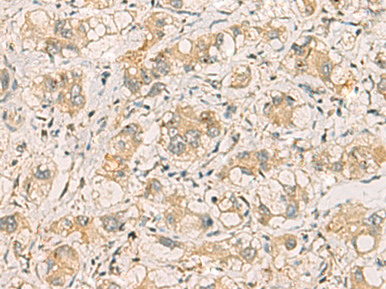 Immunohistochemistry of paraffin-embedded Human liver cancer tissue  using SQSTM1 Polyclonal Antibody at dilution of 1:40(×200)