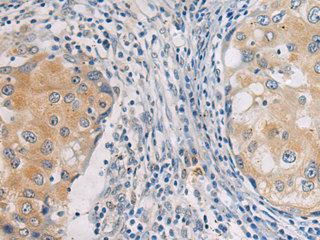 Immunohistochemistry of paraffin-embedded Human breast cancer tissue  using GBA Polyclonal Antibody at dilution of 1:55(×200)