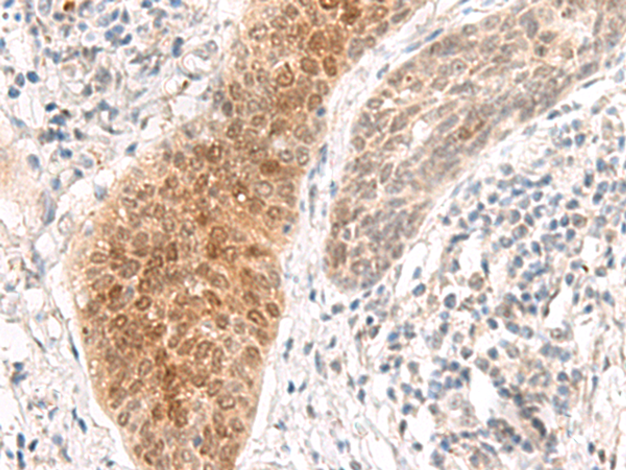 Immunohistochemistry of paraffin-embedded Human esophagus cancer tissue  using GHDC Polyclonal Antibody at dilution of 1:90(×200)